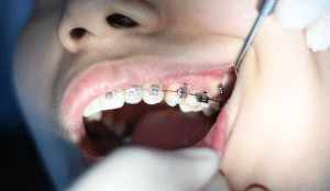 Osoba sa aparatićem kojoj zubar pregledava zube